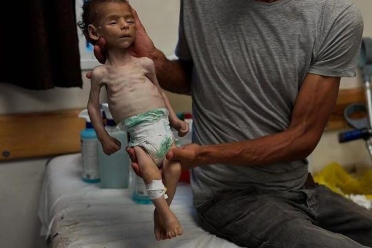 الصحة بغزة: 9 وفيات جديدة بسبب المجاعة وسوء التغذية خلال 24 ساعة