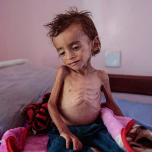 4 وفيات نتيجة المجاعة وسوء التغذية خلال الـ24 ساعة الماضية في غزة